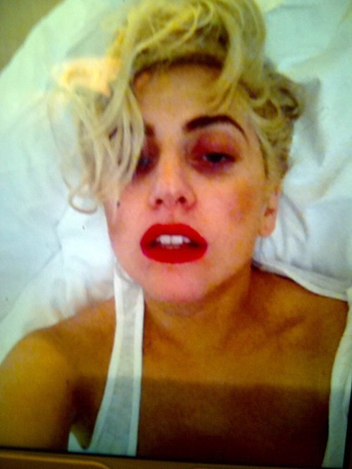 Lady Gaga получила сотрясение мозга